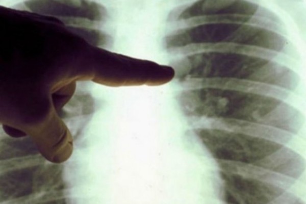 El cáncer es responsable de una de cada cuatro muertes en la Unión Europea