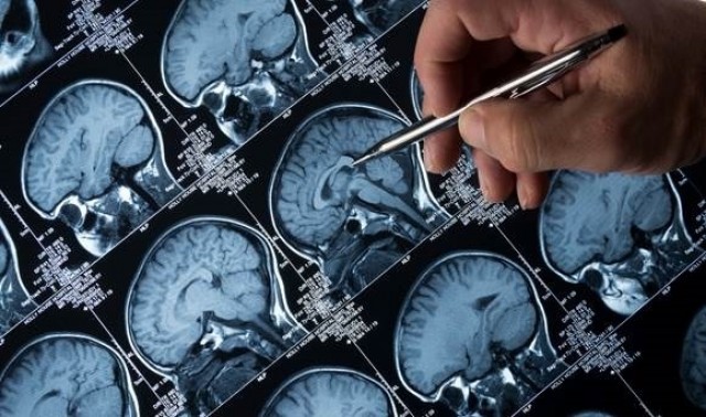 El CSIC determina el origen de las corrientes eléctricas en el cerebro de pacientes epilépticos