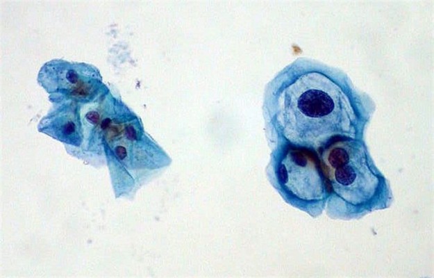Confirman que el virus del papiloma también causa cáncer de garganta