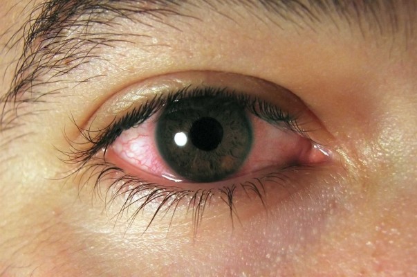 La primavera aumenta los casos de conjuntivitis alérgica por la polinización de gramíneas y olivos
