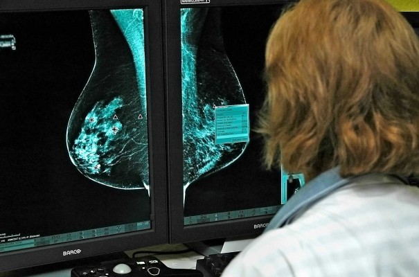 El 40% de los españoles no sabe qué es el cáncer de mama metastásico