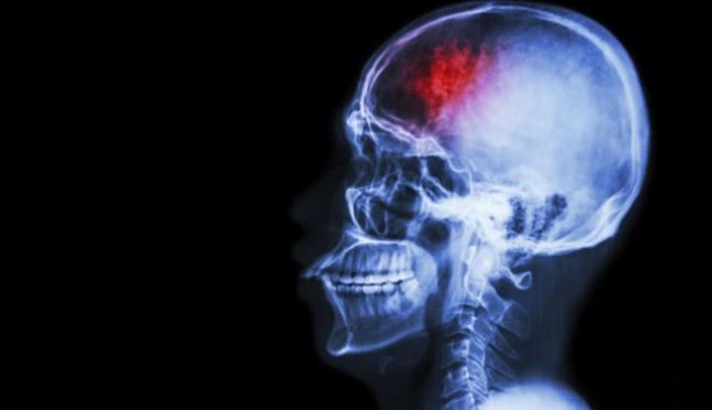 Algunas bacterias orales pueden vincularse al riesgo de ictus
