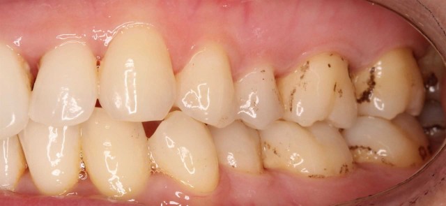 La CEU UCH logra reducir las tinciones negras de los dientes con fototerapia antimicrobiana
