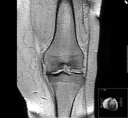La mitad de los mayores de 65 años padece artrosis de rodilla, según un experto