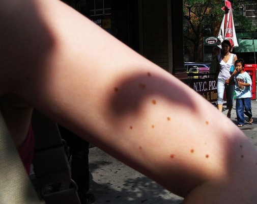 La mayoría de pacientes con melanoma tienen pocos lunares