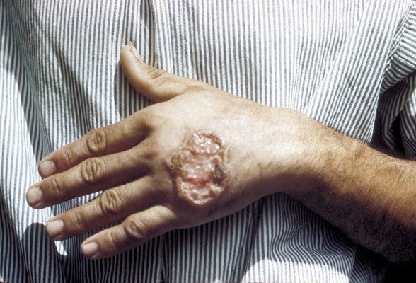 La leishmaniasis afecta a dos millones de personas y otros 350 millones están en riesgo de padecerla