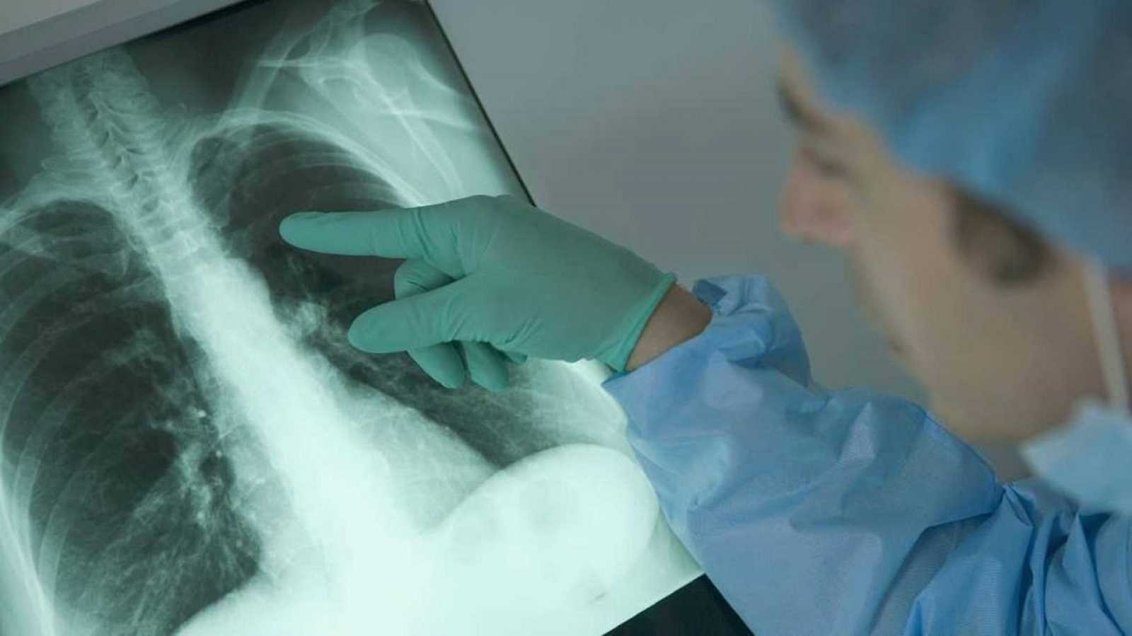 La mortalidad por cáncer de pulmón entre las mujeres aumentará en más del 40% para 2030