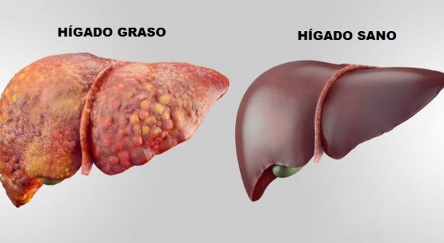 La reducción de amonio en sangre puede ayudar a tratar casos graves de hígado graso no alcohólico