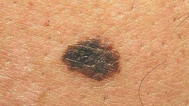 Identifican los genes involucrados en el riesgo de sufrir cáncer de piel
