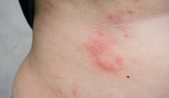 Hasta el 60% de las personas que sufre urticaria crónica desarrolla su variante espontánea