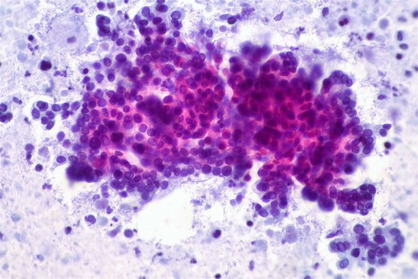Casi 8.000 españoles son diagnosticados con cáncer de páncreas cada año, según SEOM