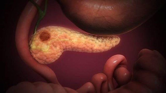 ACANPAN hace un llamamiento urgente para mejorar la investigación y el diagnóstico precoz del cáncer de páncreas
