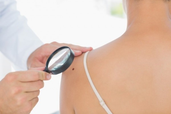 Casi el 80% de los españoles en edad adulta no ha acudido al dermatólogo para revisarse los lunares