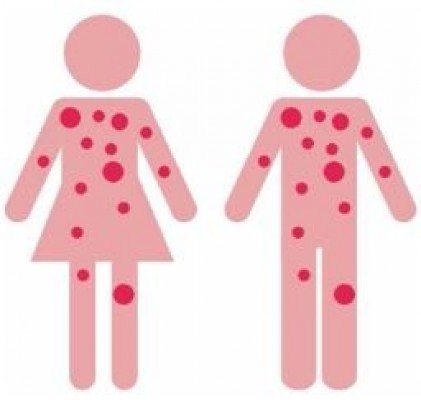 La poca visibilidad de la urticaria hace que falte información por parte de los médicos