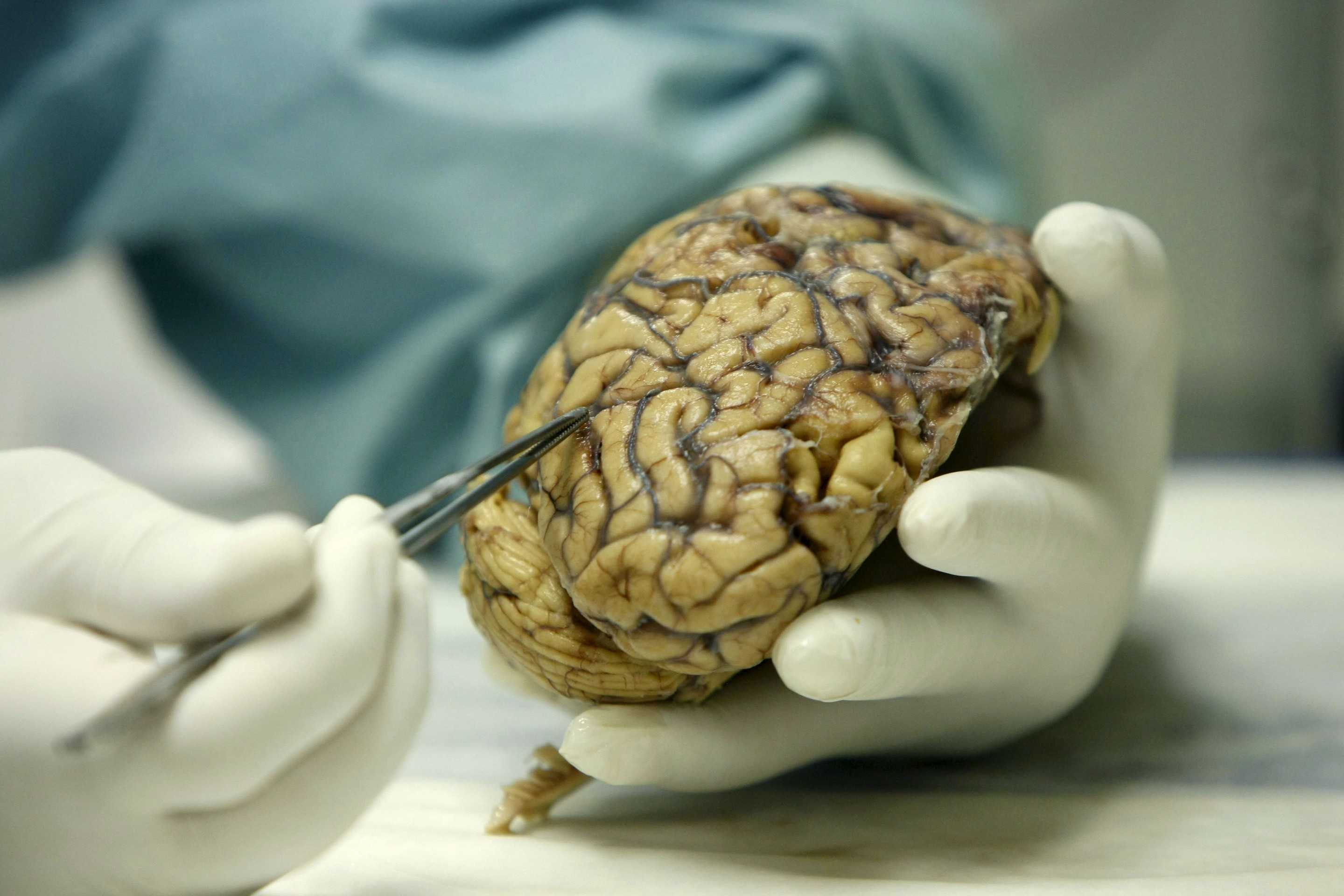 Un estudio muestra efectos beneficiosos de bloquear la inflamación del cerebro en el Alzheimer