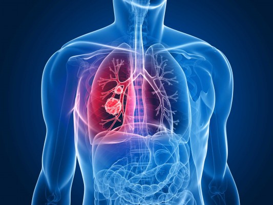El cáncer de pulmón femenino aumenta un 30% en cinco años