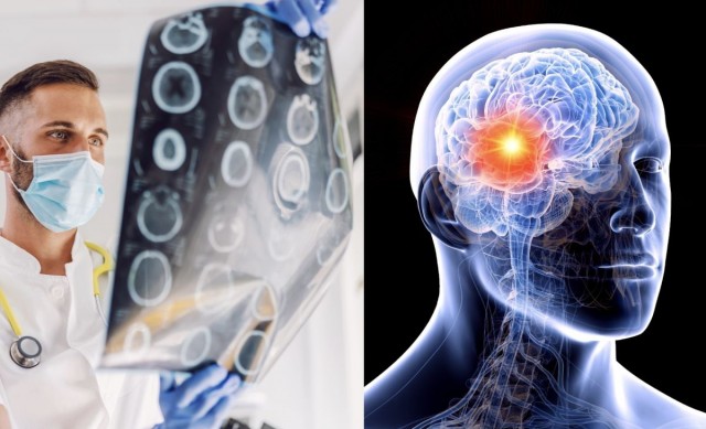 El glioblastoma sigue sin cura pero la investigación avanza