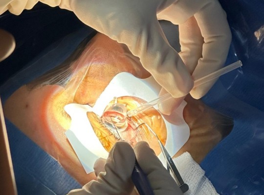 El Hospital Clínico de València incorpora nueva técnica láser menos invasiva para glaucoma
