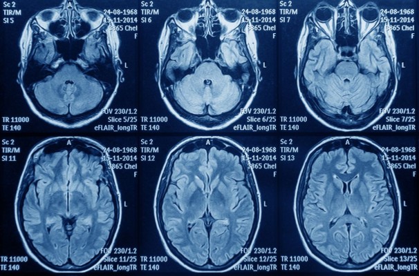 Astuce denuncia que pacientes con glioblastoma 
