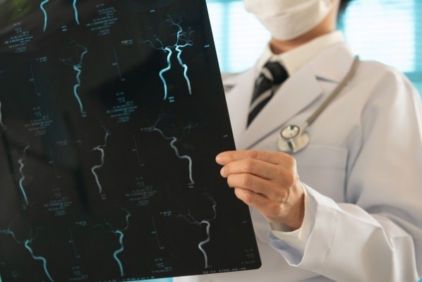 Expertos resaltan el margen de mejora que existe en la prevención, manejo y rehabilitación del ictus
