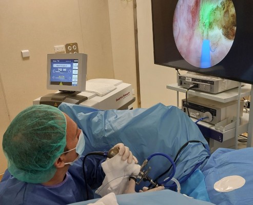 La fotoenucleación prostática por láser, mejor opción para casos complejos de hipertrofia prostática