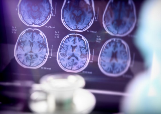 Los síntomas de padecer Alzheimer comienza una década antes, según especialistas de Vithas
