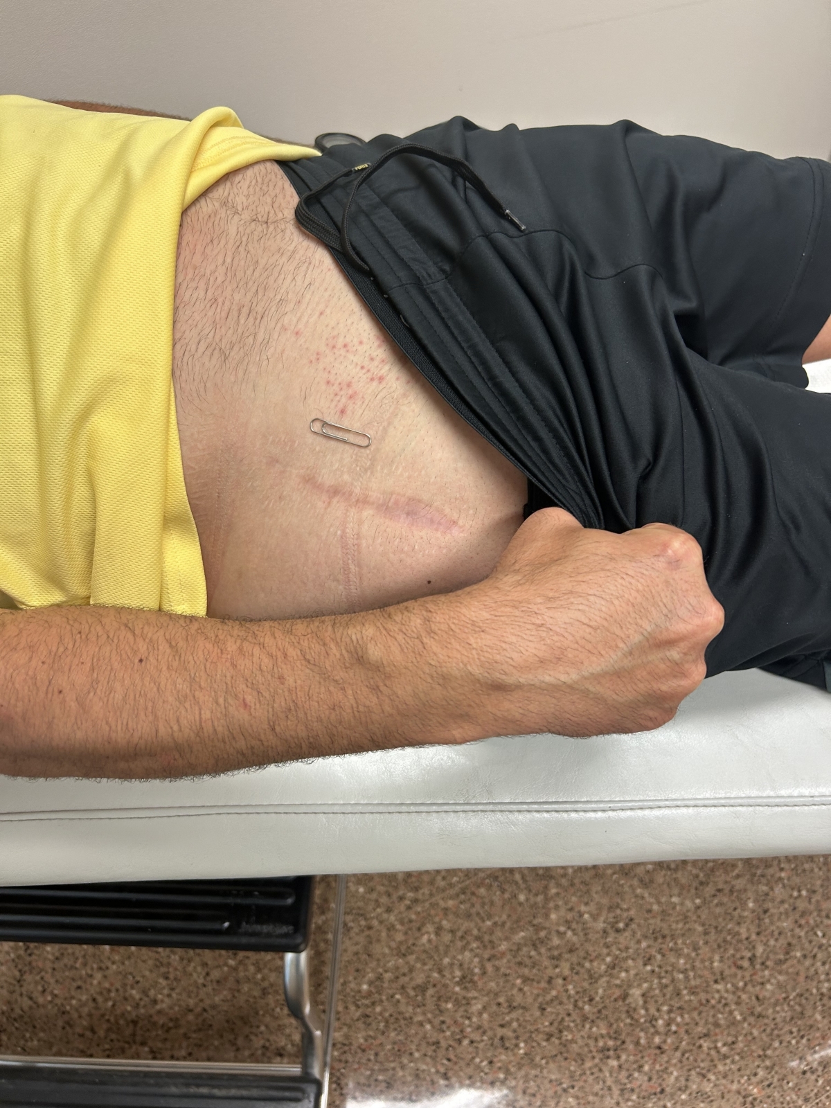 Vithas Valencia Turia refuerza su apuesta por la experiencia paciente e incorpora una técnica de vanguardia en cirugía de prótesis de cadera 