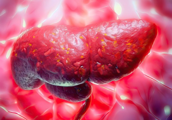 Una prueba genética permitirá a los pacientes con enfermedad hepática grave mejorar la eficacia de sus tratamientos