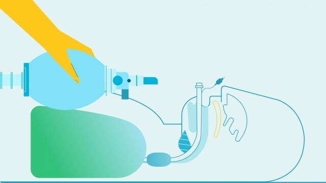 Un proyecto de la Fundación del Hospital General de Valencia desarrolla un tubo endotraqueal expansible