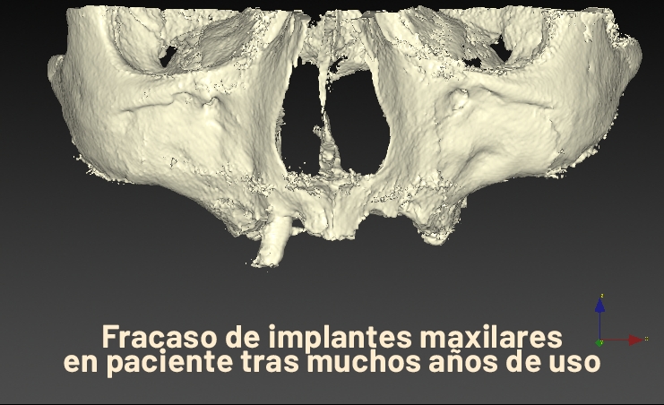 Rubén Davó lidera un estudio que avala la técnica 'Quad Zygoma' para implantes maxilares fallidos