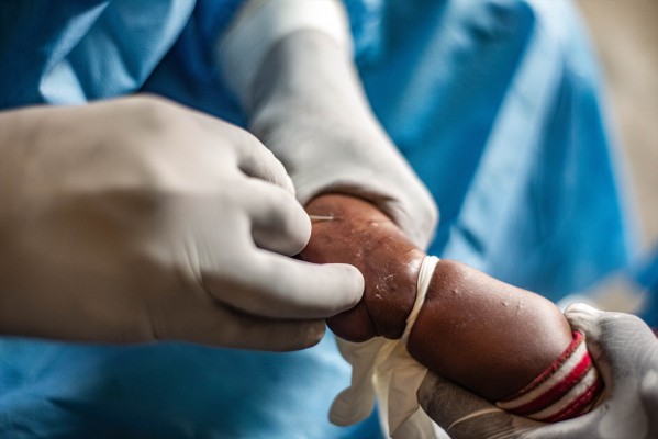 España participa este lunes en una reunión con países de la UE para analizar la emergencia sanitaria de mpox
