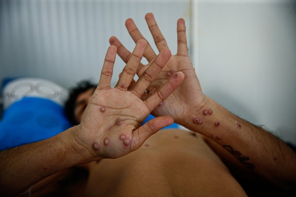 Sanidad recuerda que los casos de mpox de este año no difieren de los que ya había desde 2022