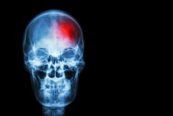 Las mujeres que sufren un ictus tienen un 25% más de riesgo de ser diagnosticadas de forma inadecuada