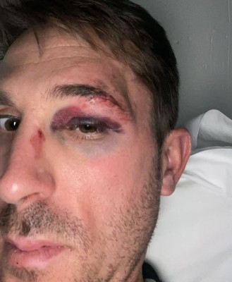 Rubén Fernández es atropellado y sufre rasguños cuando preparaba la Vuelta

