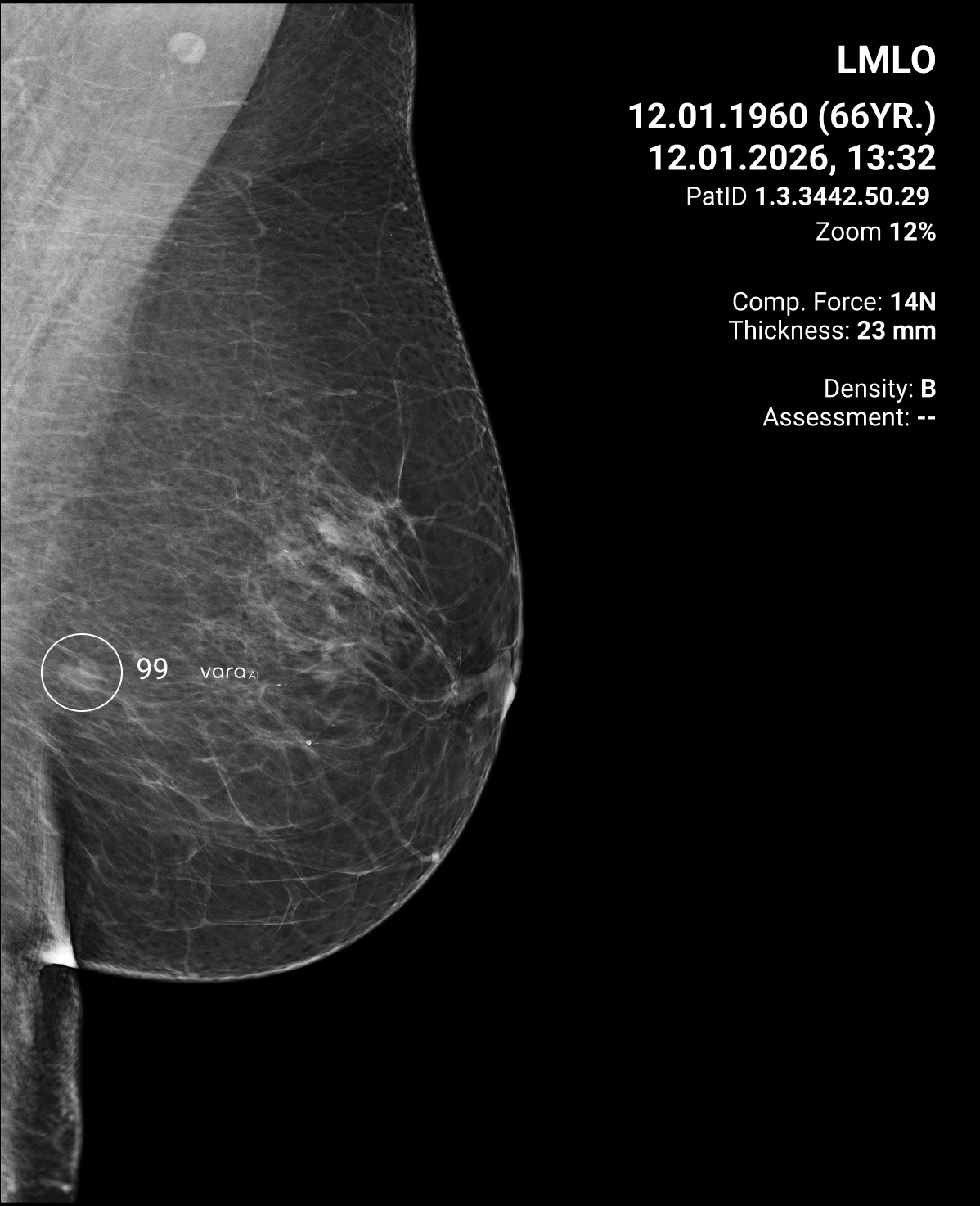 Quibim se alía con la alemana Vara para desplegar en España la IA para cribado de mama más avanzada de Europa