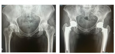 Vithas Valencia Turia, primer hospital privado de la provincia en completar con éxito la cirugía bilateral de cadera simultánea por vía anterior
