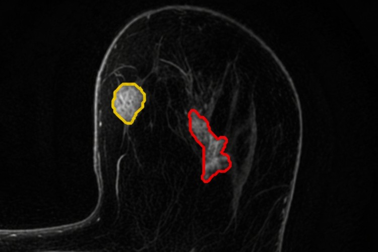 La española Quibim crea la primera IA para detectar el cáncer de mama por resonancia