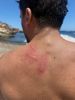 ¿Frío o calor? La clave para actuar ante medusas, peces araña, avispas y abejas este verano