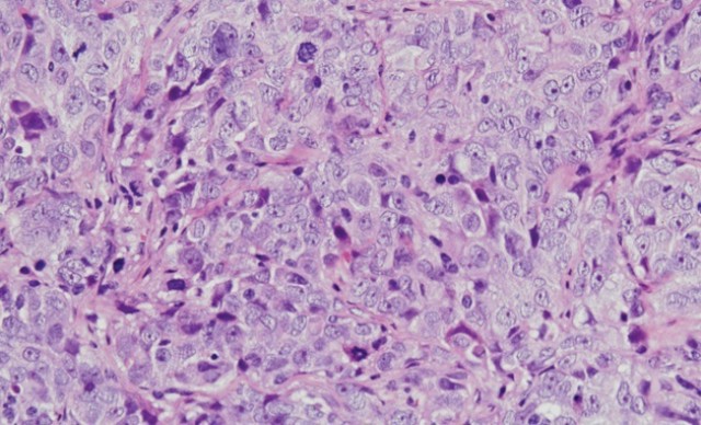 El tratamiento y la operación del cáncer de ovario