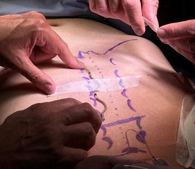 Implantan un desfibrilador extravascular sin conectar cables al corazón a través de las venas