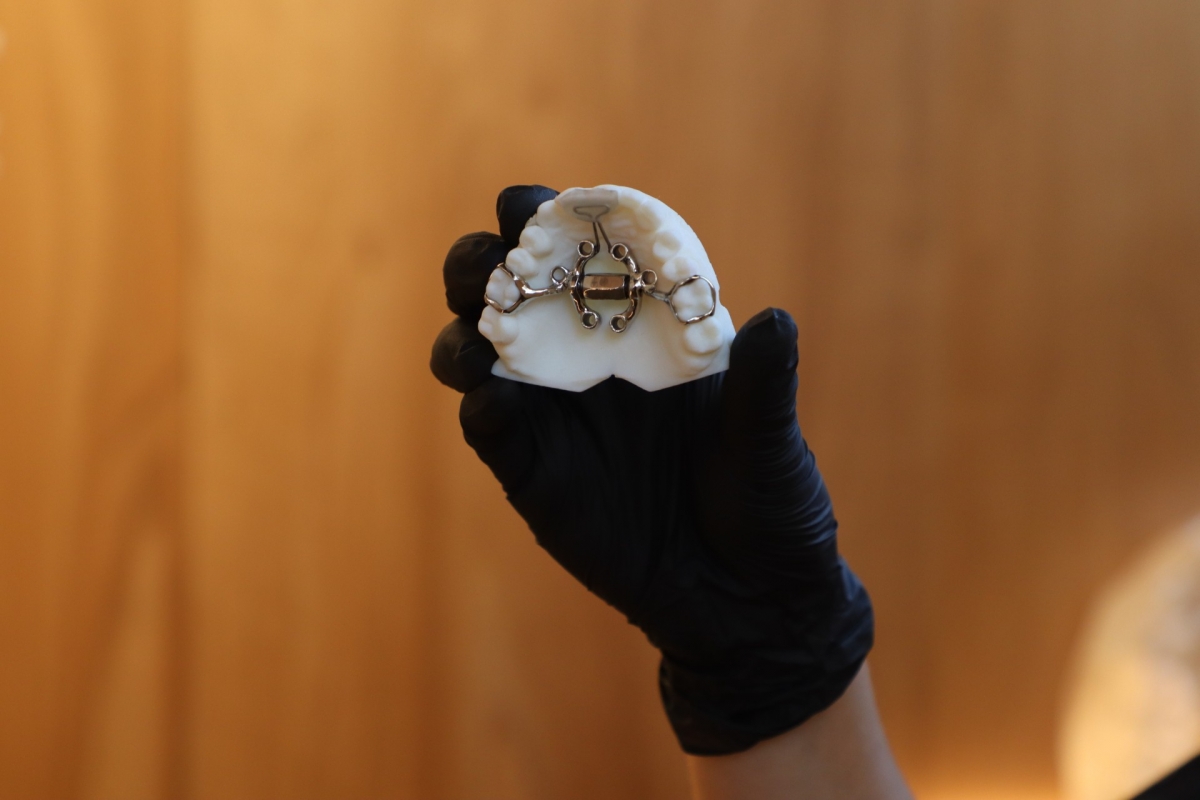 El expansor MARPE se ancla al hueso del paladar con microtornillos y va alojado dentro de la boca.
