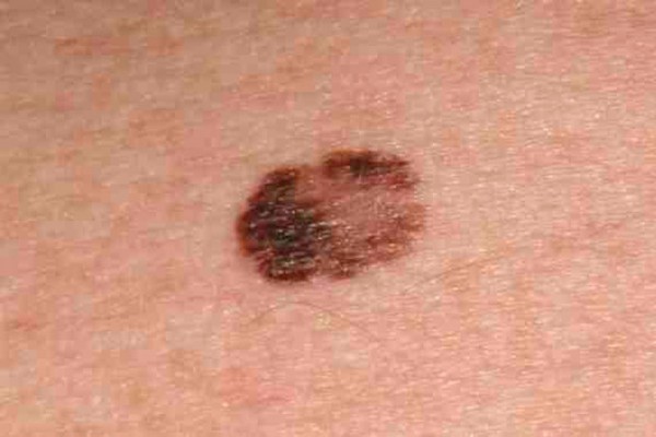 Alrededor de 4.000 nuevos casos de melanoma se diagnostican en España cada año