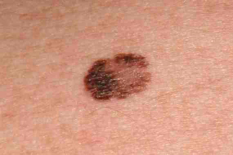 Alrededor de 4.000 nuevos casos de melanoma se diagnostican en España cada año