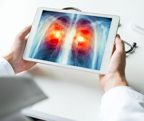 Investigadores encuentran nuevas vías para tratar el cáncer de pulmón en quienes nunca han fumado

