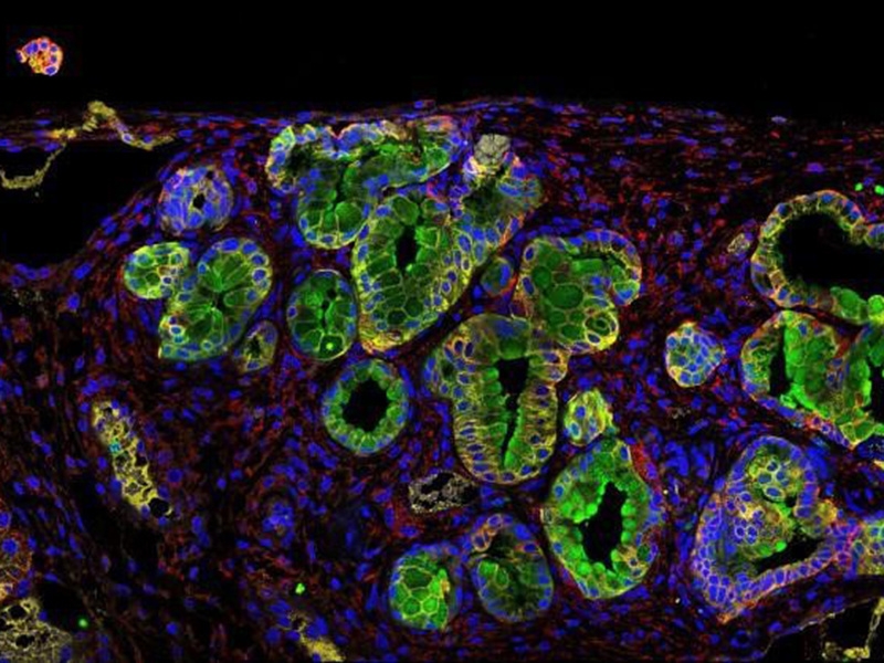 Una proteína antibacteriana, nueva diana terapéutica contra el cáncer de páncreas