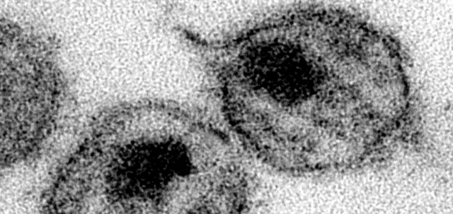 Un estudio del ISCIII revela que existe una elevada proporción de diagnóstico tardío en los casos de VIH
