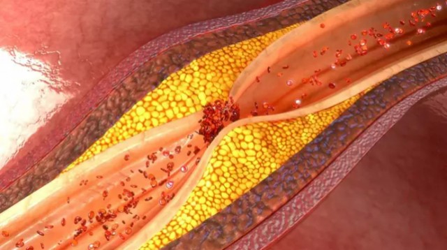 Descubren rasgos cancerígenos en la aterosclerosis, lo que abre la puerta a nuevos tratamientos
