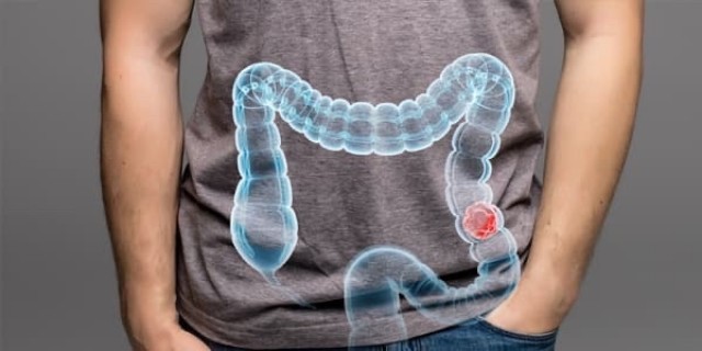 Los diagnósticos de cáncer colorrectal cada vez son más jóvenes, pero no acuden al médico enseguida