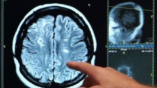 Los factores sociales y ambientales pueden aumentar el riesgo de padecer cardiopatías e ictus