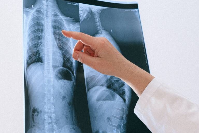 Las enfermedades pulmonares aumentan el riesgo de cardiopatías, según un estudio